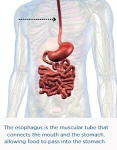 PD and Dysphagia, achalasia
